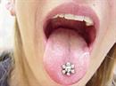 Metalle im Mund können Zunge, Zähne und Zahnfleisch schädigen.